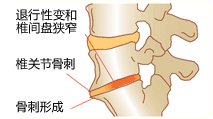 脊柱骨性关节炎