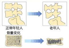 骨质疏松