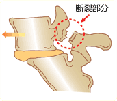 腰椎峡部裂(滑脱)