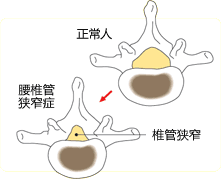 腰椎管狭窄症