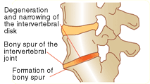 Osteoarthritis of the spine