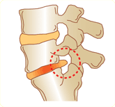 Lumbar disk herniation