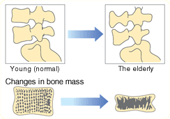 Lumbar disk herniation