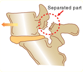 Lumbar spondylolysis (spondylolisthesis)