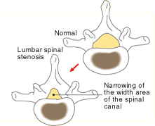 Lumbar spinal stenosis