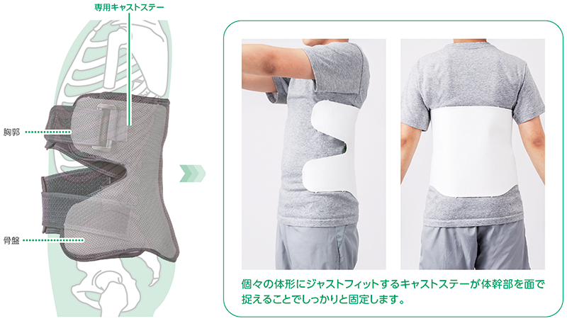 腰椎の「伸展＋回旋」を抑制するキャストステー構造