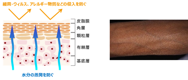 左：皮膚断面図／右：ドライスキン状態の皮膚