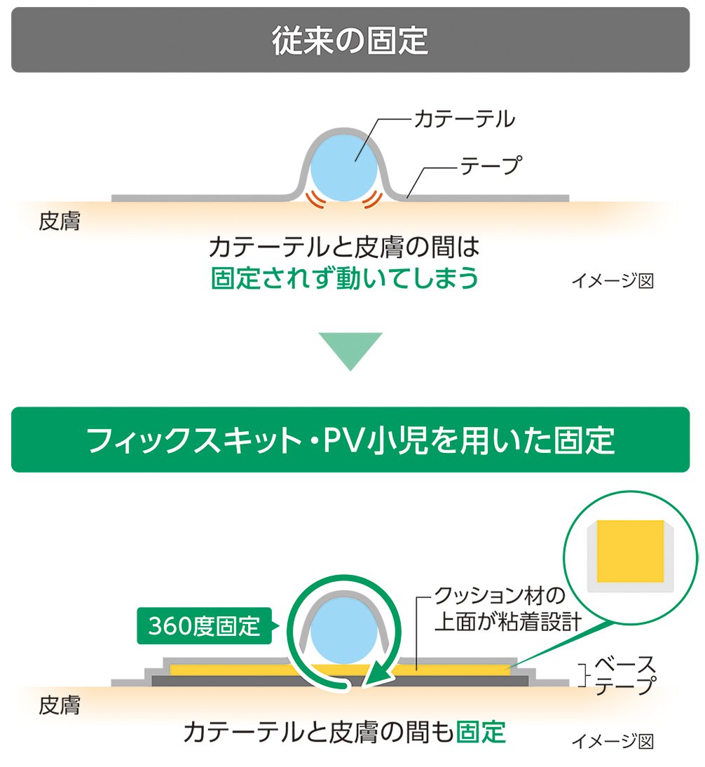 従来の固定とフィックスキット・PV小児を用いた固定の比較イメージ図
