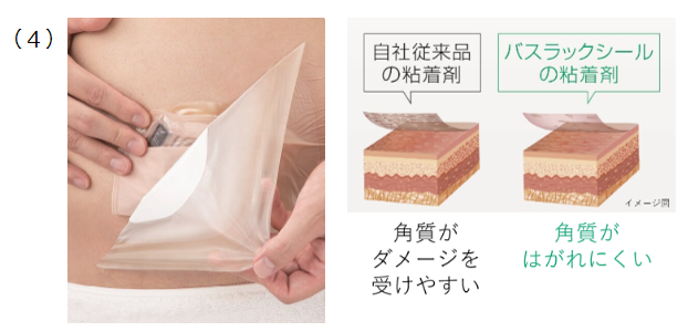 オストメイトへの親切設計(4)角質がはがれにくい接着剤の画像イメージ